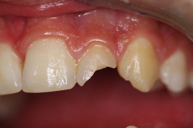 Trauma dentale