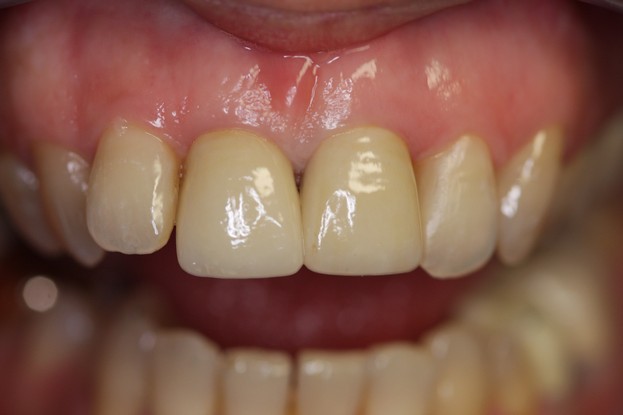 Protesi fissa in Zirconia-Ceramica